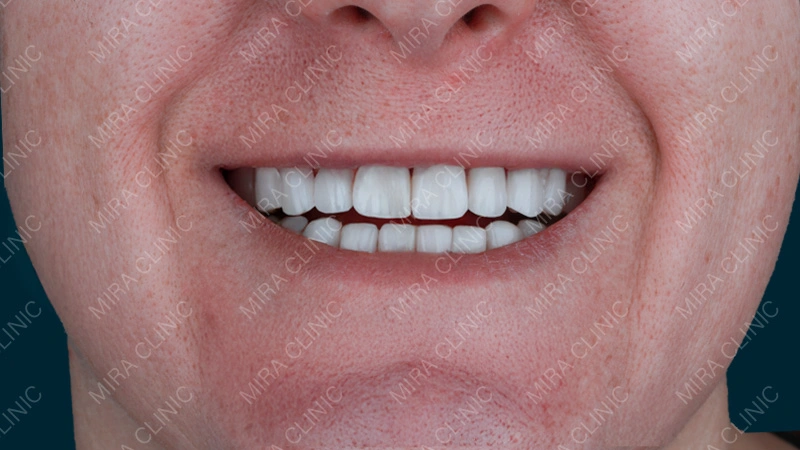 Final Hollywood Smile Reveal